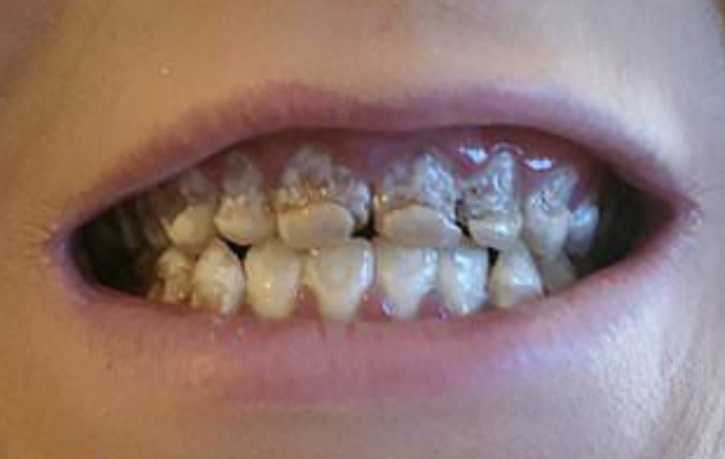 Así le quedó la dentadura por tomar 6 bebidas energéticas diarias durante seis meses 6 Captura de pantalla 2019 02 15 a las 12.18.06