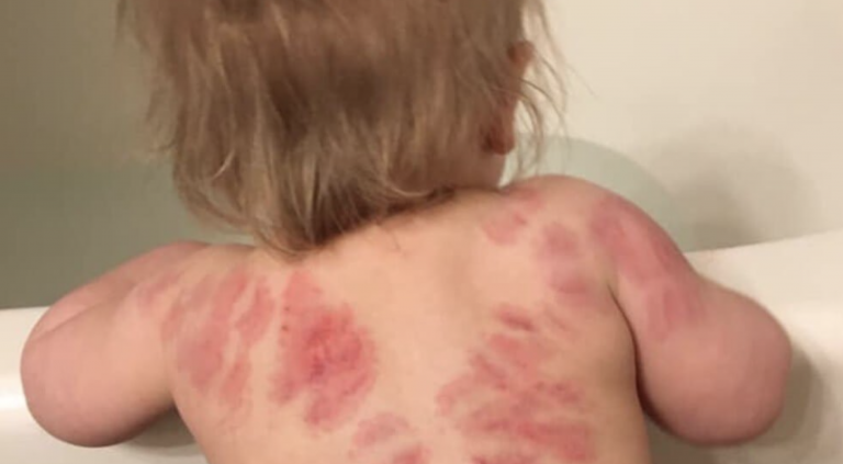 Recoge a su hija de la guardería con 25 mordeduras en el cuerpo