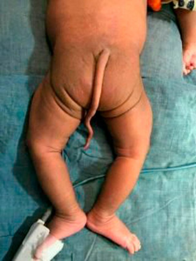 Una bebé nace en Colombia con cola vestigial 1 18 06 19 bebe03