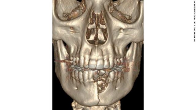 190618170429 01 e cig explosion teen exlarge 169