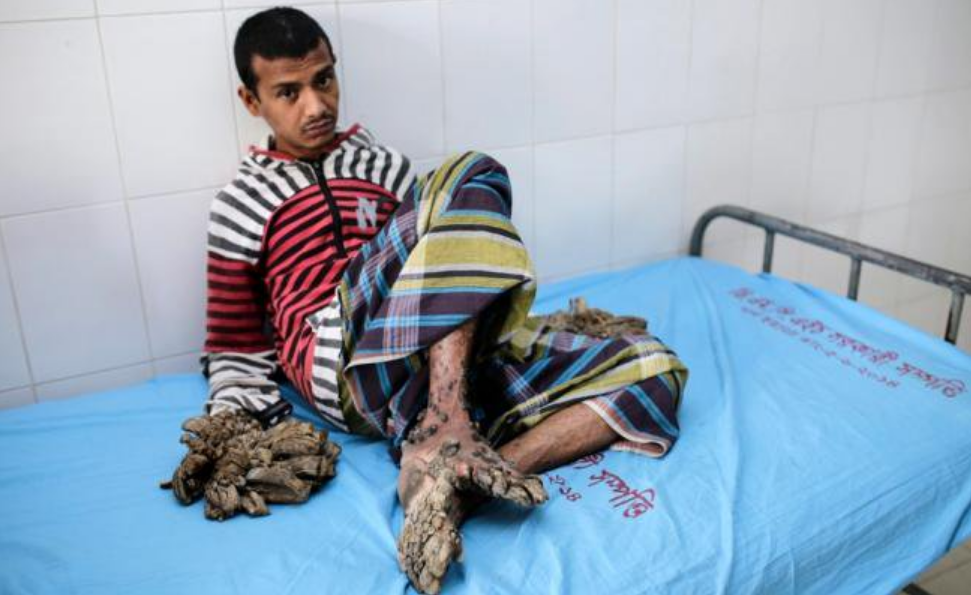 El 'hombre árbol' no aguanta más y pide que le corten las manos 1 arbol