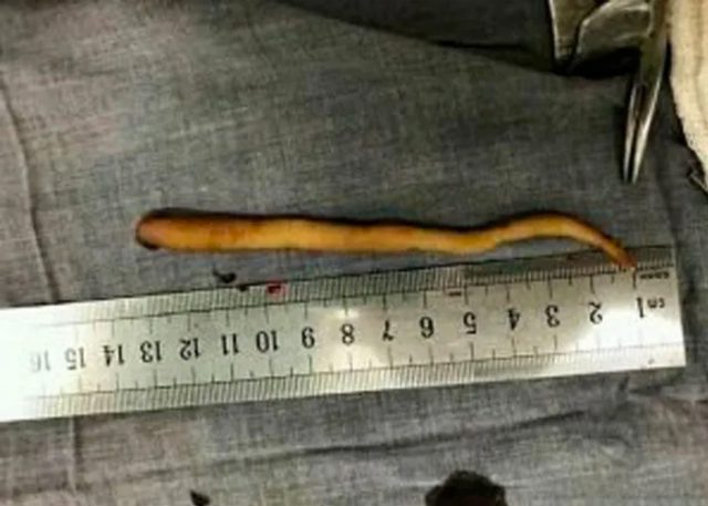 Una bebé nace en Colombia con cola vestigial 3 cola bebe cirugia colombia