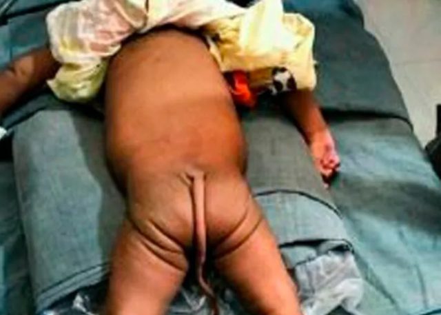 Una bebé nace en Colombia con cola vestigial 2 cola bebe colombia