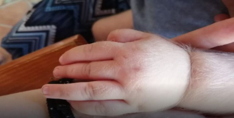 Ya son 20 los bebés afectados por el 'síndrome del hombre lobo'