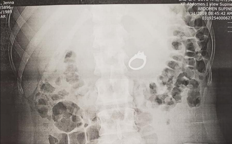 Una mujer sueña con tragarse su anillo de compromiso y se despierta con la joya en el estómago