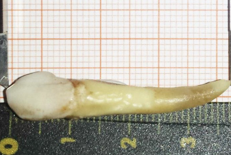 Extraen a un paciente un diente de casi 4 centímetros en Alemania