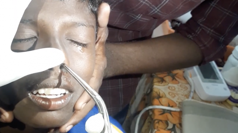 Extraen un pez con vida de la nariz de un paciente