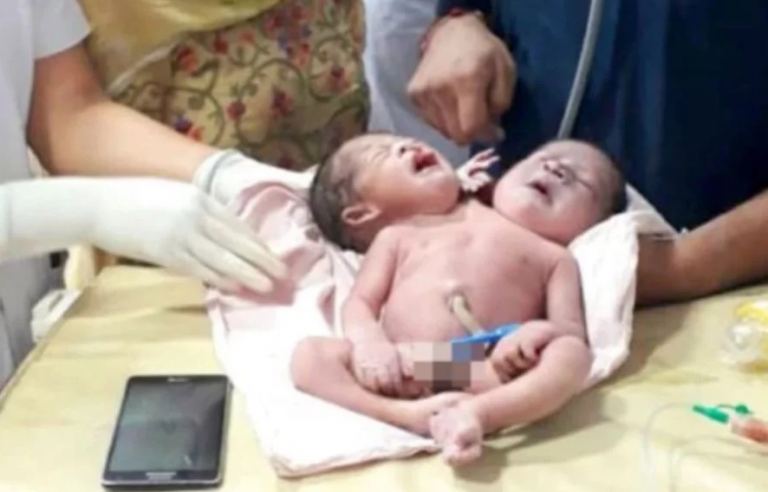 Creía que tendría gemelos y parió un bebé con dos cabezas y tres brazos