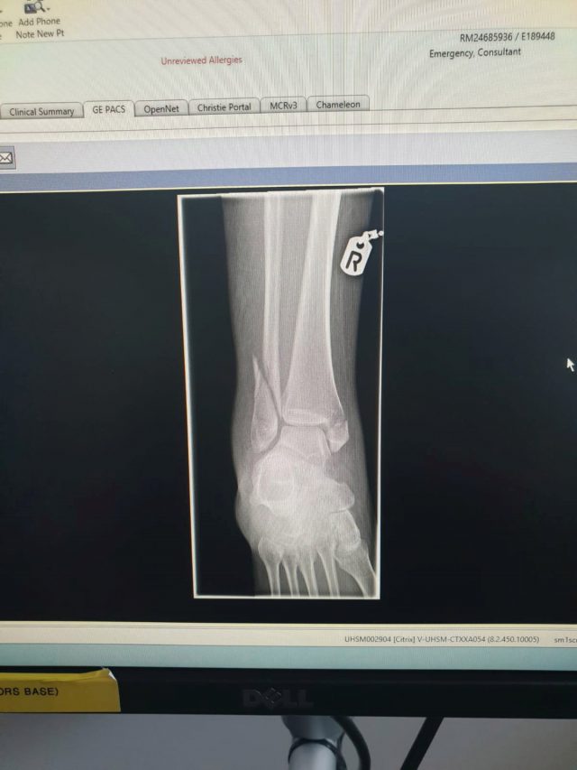 Una azafata se rompe la pierna en siete partes durante las turbulencias en un vuelo 2 NINTCHDBPICT000550066280