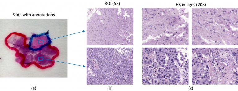 El IUMA ha logrado una herramienta hiperespectral que ayuda al diagnóstico para la detección de tumores cerebrales de algo grado