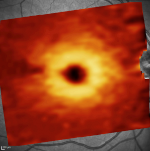 Fondo de ojo donde se representa el mapa del espesor de las células ganglionares a nivel macular