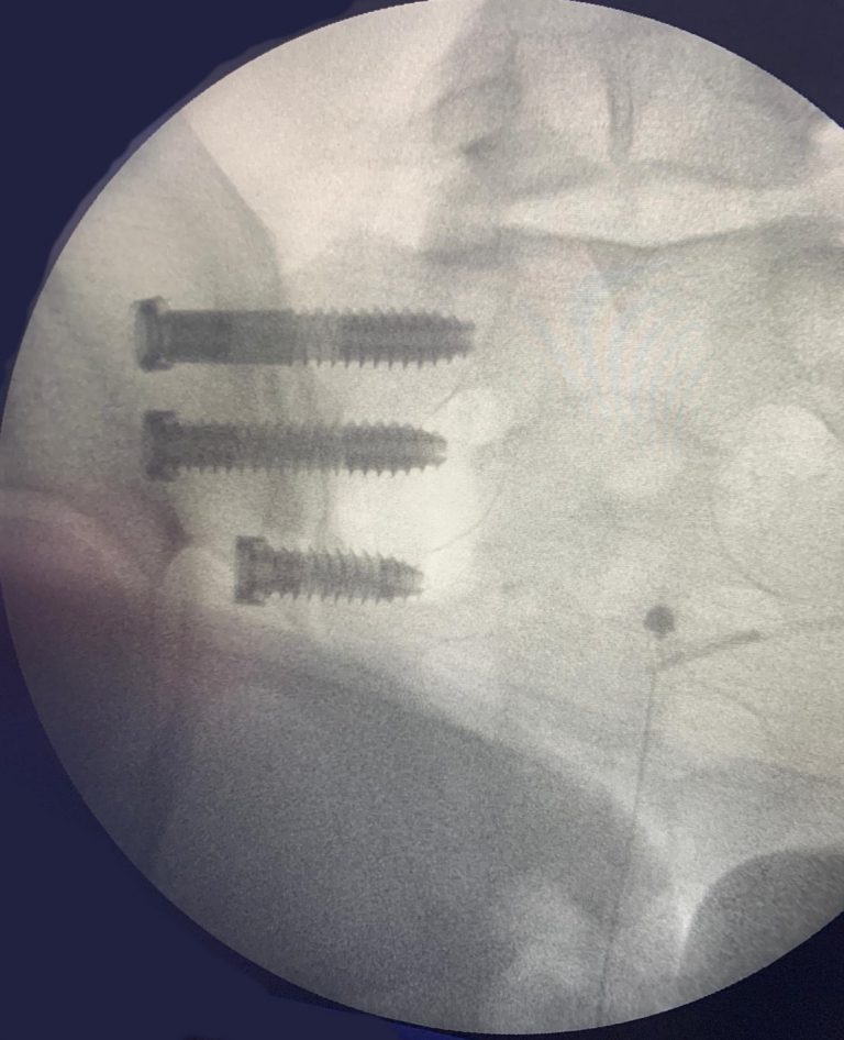 El HUC realiza una nueva técnica quirúrgica para la articulación sacroilíaca de la columna vertebral
