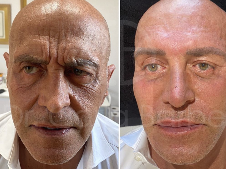 Irreconocible: la desastrosa operación estética de Kiko Matamoros