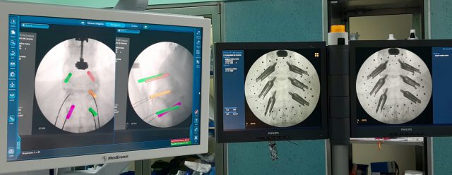 Intervención columna con navegador HUC 2