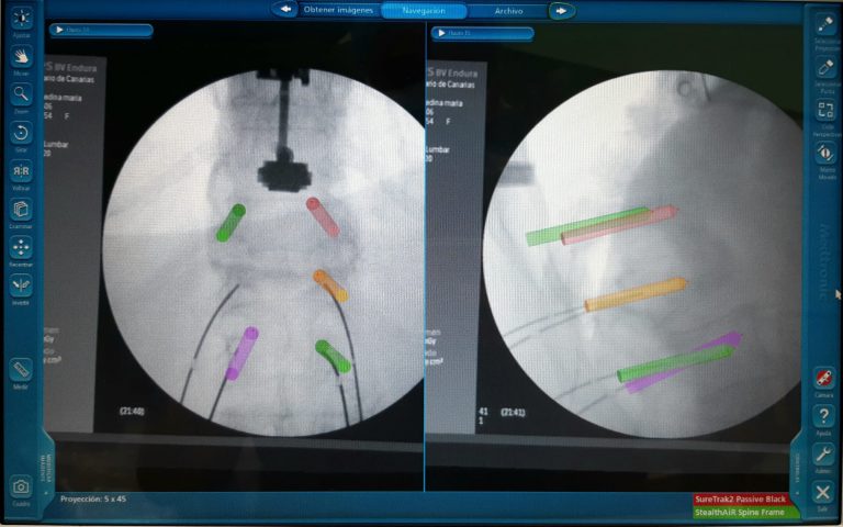Neurocirugía del HUC realiza intervenciones de columna mediante navegador