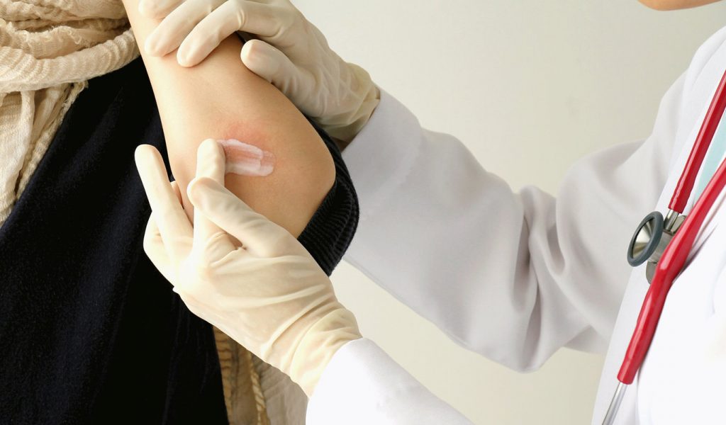 Qué hacer si te pica una avispa