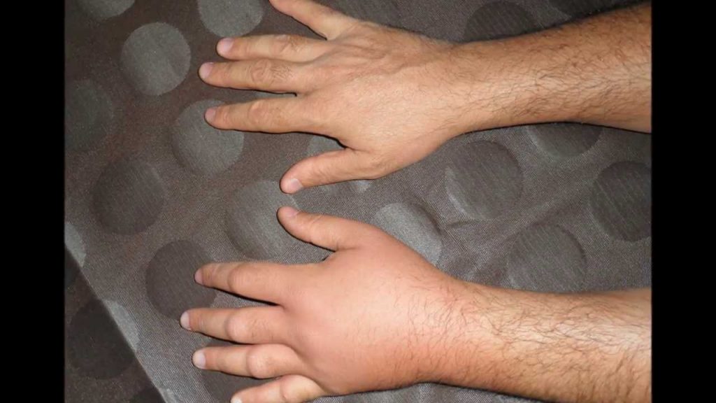 Qué hacer si te pica una avispa