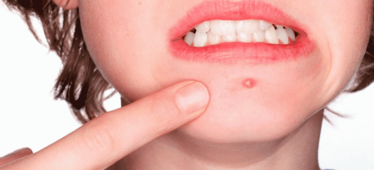 Prepara tu armamento para deshacerte de esos granos que no has pedido