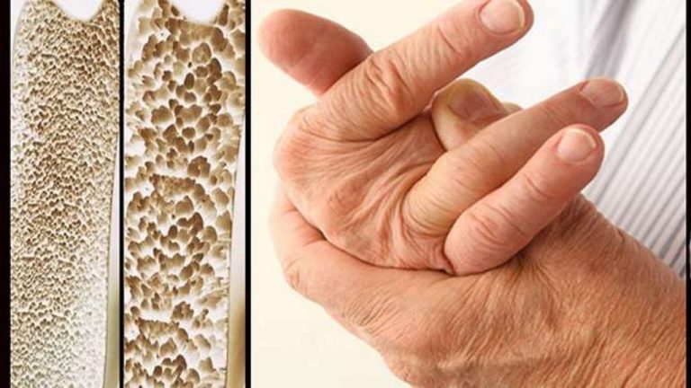 Alcoholismo, enfermedades inflamatorias, hepáticas y renales pueden causar osteoporosis