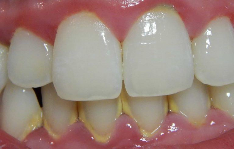 Cómo eliminar el sarro de tus dientes