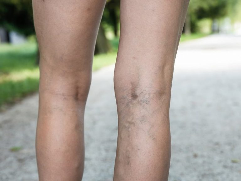 La secuenciación masiva del ADN podría ayudar a detectar trombosis