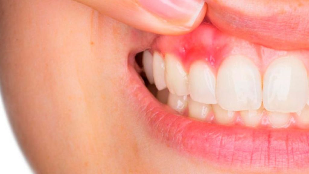 comienzo de gingivitis