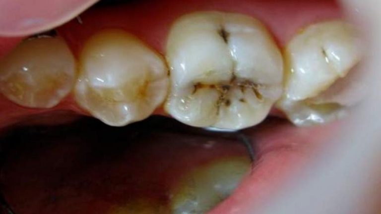 Dentistas advierten que una mala higiene bucal se relaciona con un peor pronóstico de Covid-19