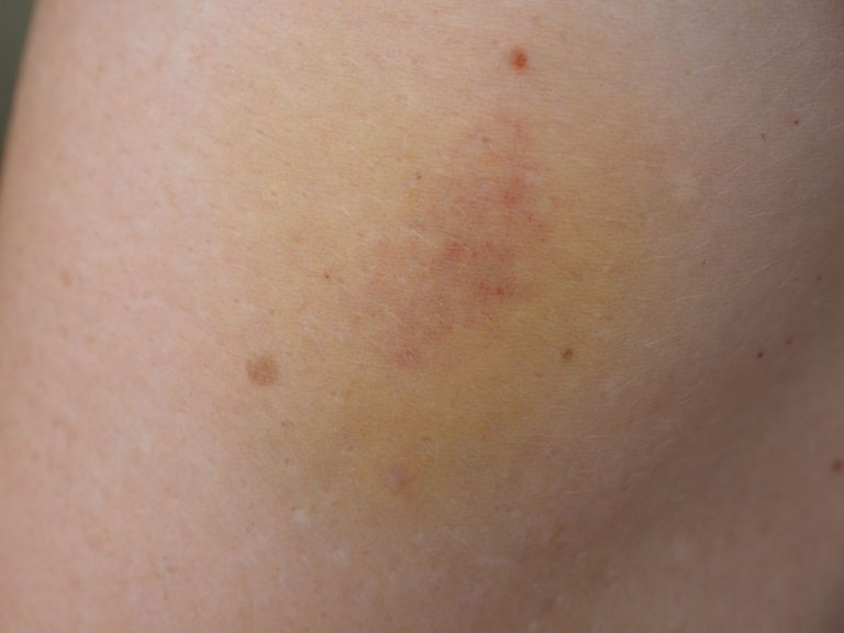 Cómo quitar un chupetón