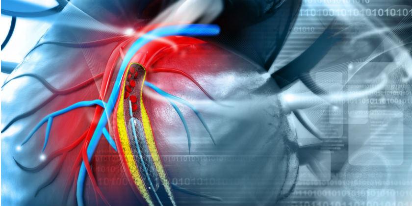 Cómo es el proceso para desobstruir la arteria