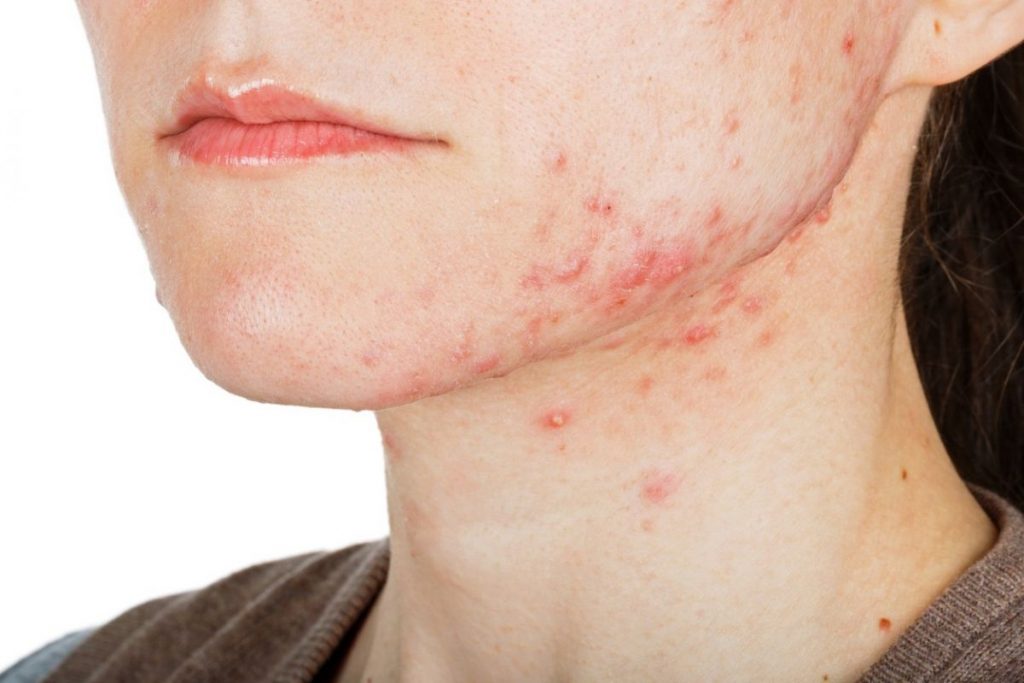 Errores que cometes cuando te sale un grano