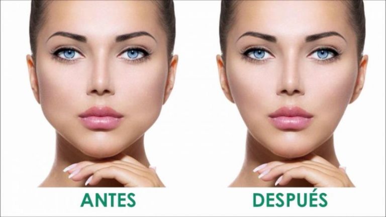 Qué es bichectomía