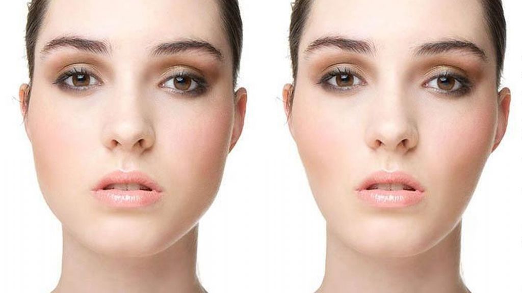 Qué es bichectomía 2 Por que someterse a una bichectomía