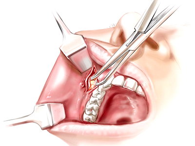Qué es bichectomía 6 Procedimiento quirurgico de la misma