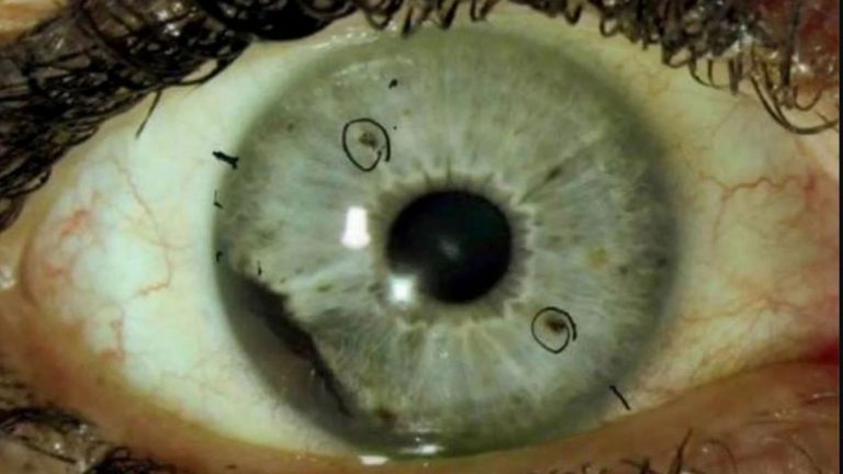 Avances de la proteína Adamts 1 en el desarrollo del melanoma uveal