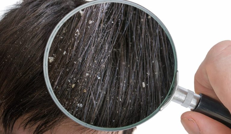 Cómo eliminar la caspa