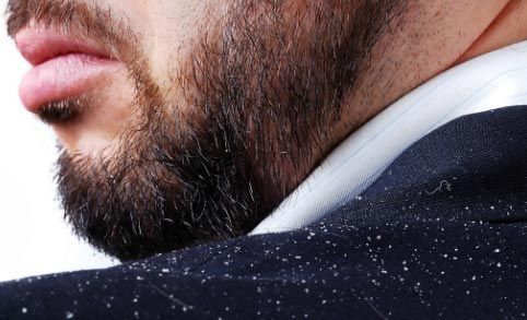 Cómo eliminar la caspa 1 eliminar la caspa