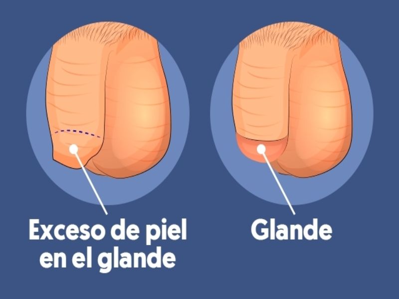 Qué es la fimosis 6 como prevenir esta enfermedad