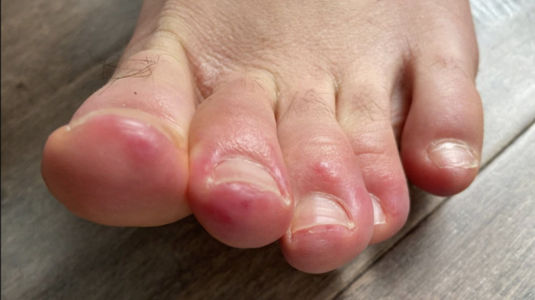 Nuevo síntoma del coronavirus: qué debes mirar en tus pies