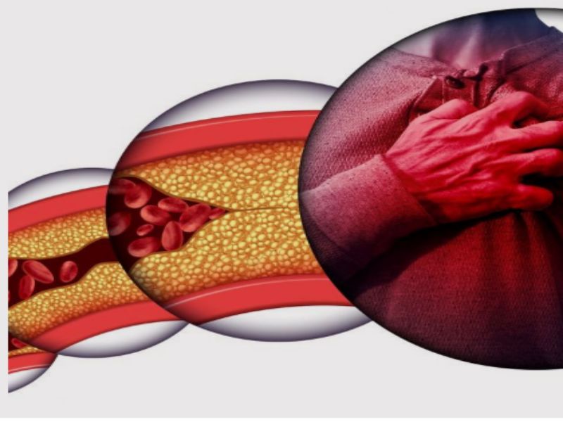 Que es dislipemia 3 dislipemia