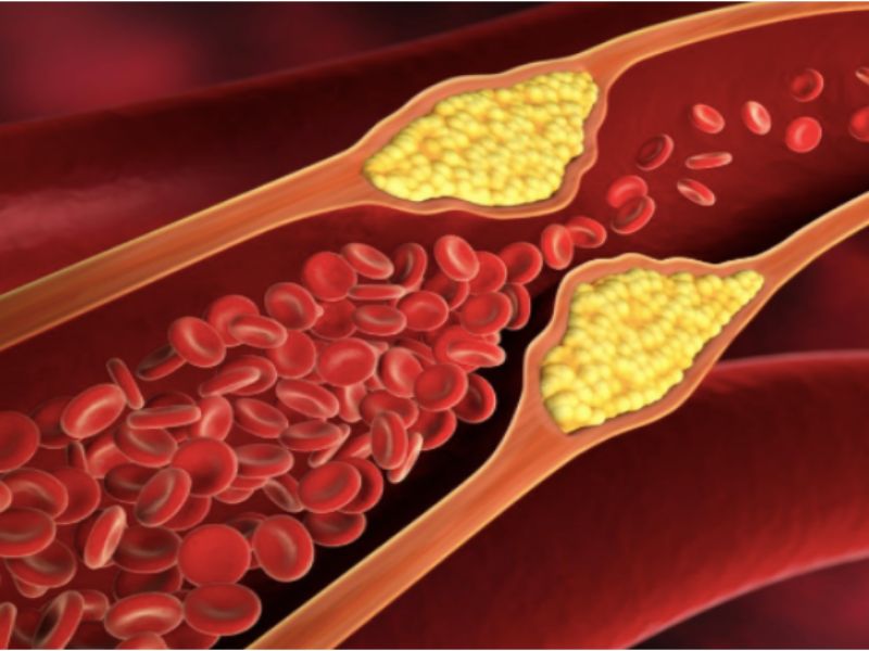 Que es dislipemia 1 Dislipemia