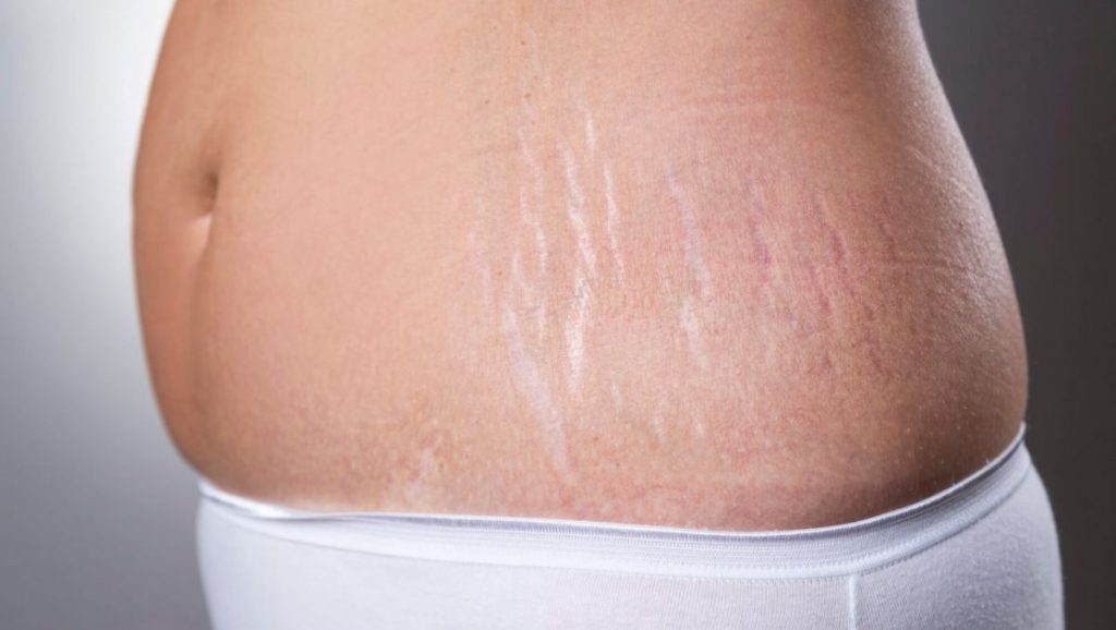 Así puedes eliminar las estrías de tu piel 3 estrias3