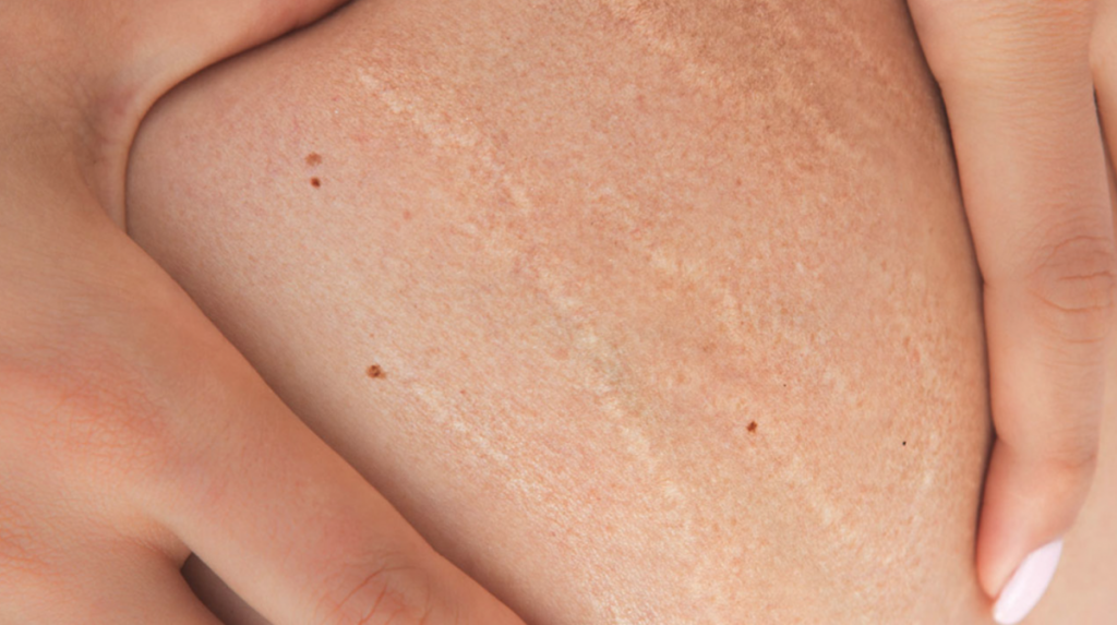 Así puedes eliminar las estrías de tu piel 4 estrias4