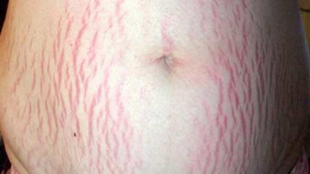 Así puedes eliminar las estrías de tu piel 5 estrias5 portada 1