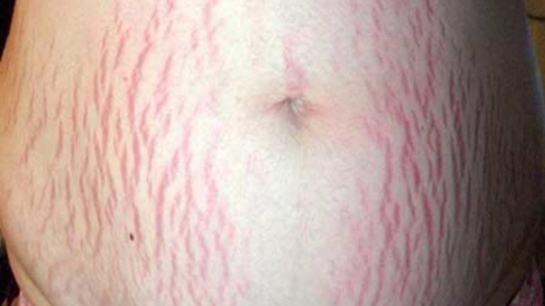 Así puedes eliminar las estrías de tu piel