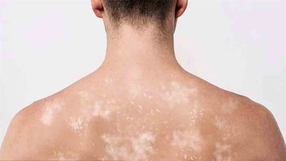 ¿Qué ocasiona la reproducción de hongos?