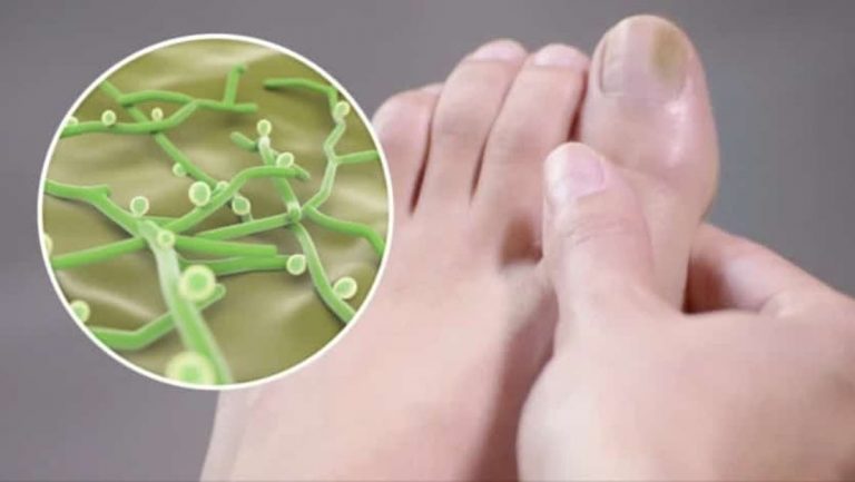 Cómo eliminar los hongos de las uñas