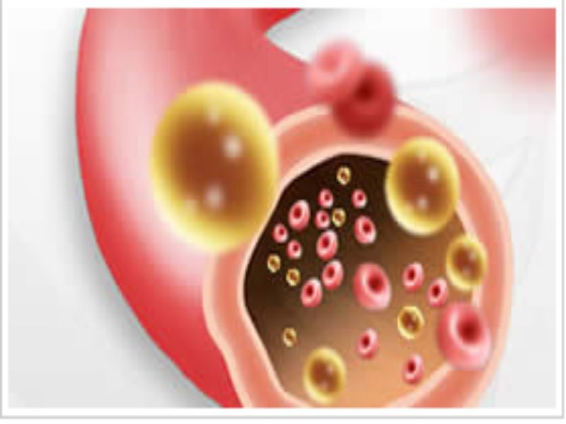 Que es dislipemia 2 lipidos