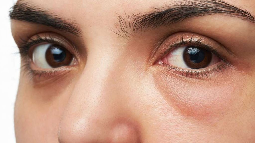 Cómo quitar las ojeras 2 Como se crean las ojeras