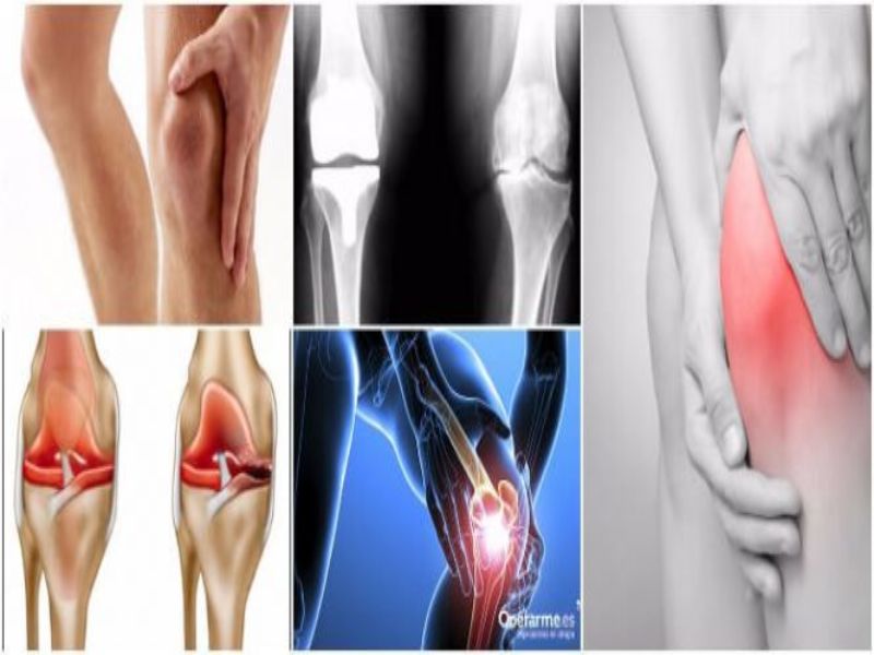 Qué es la artrosis 2 origen de la artrosis