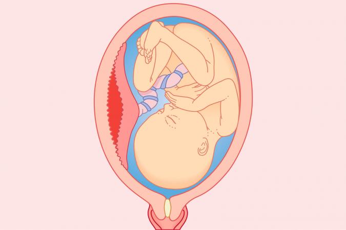 Placenta retenida: 